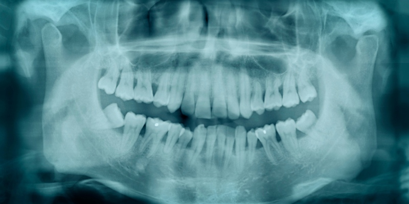 ปัญหาฟันซ้อน ฟันเก รักษาด้วยการจัดฟัน