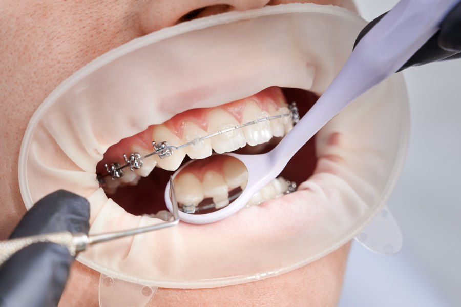การจัดฟันแบบเซรามิกแตกต่างจากจัดฟันโลหะอย่างไร ?