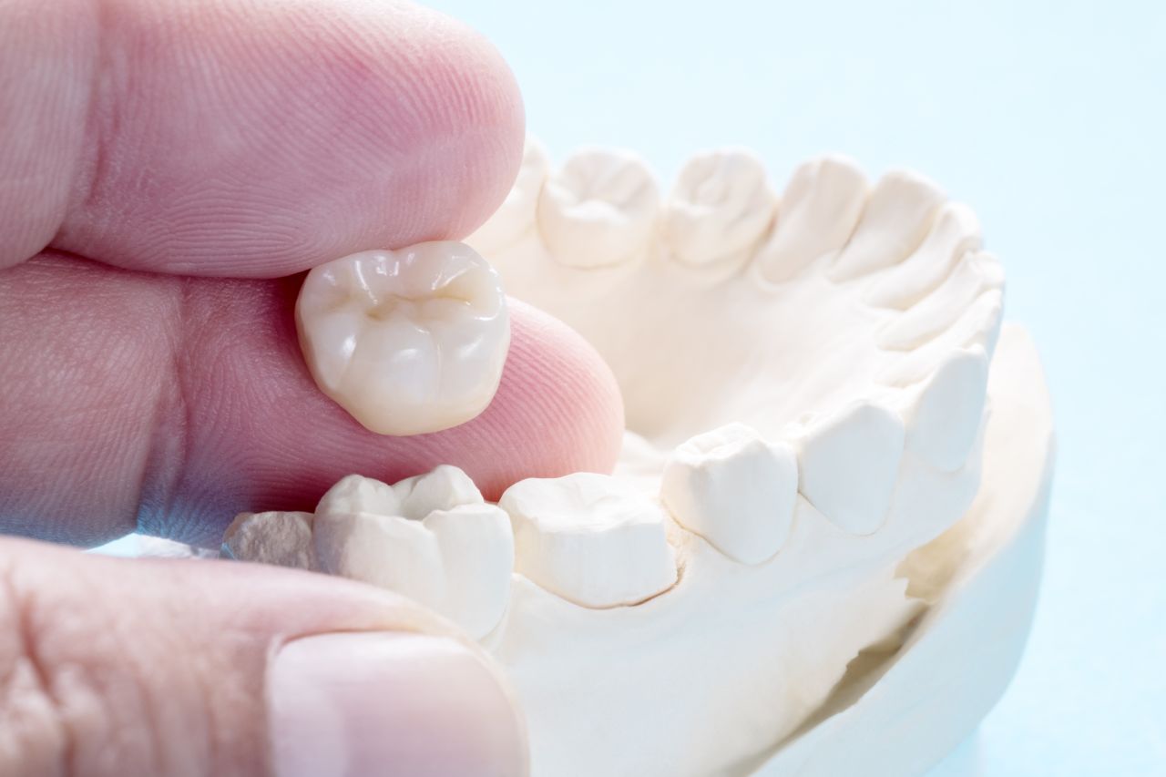 ครอบฟัน อยู่ได้นานขนาดไหน มีวิธีดูแลอย่างไรให้สามารถอยู่ได้นาน ๆ 