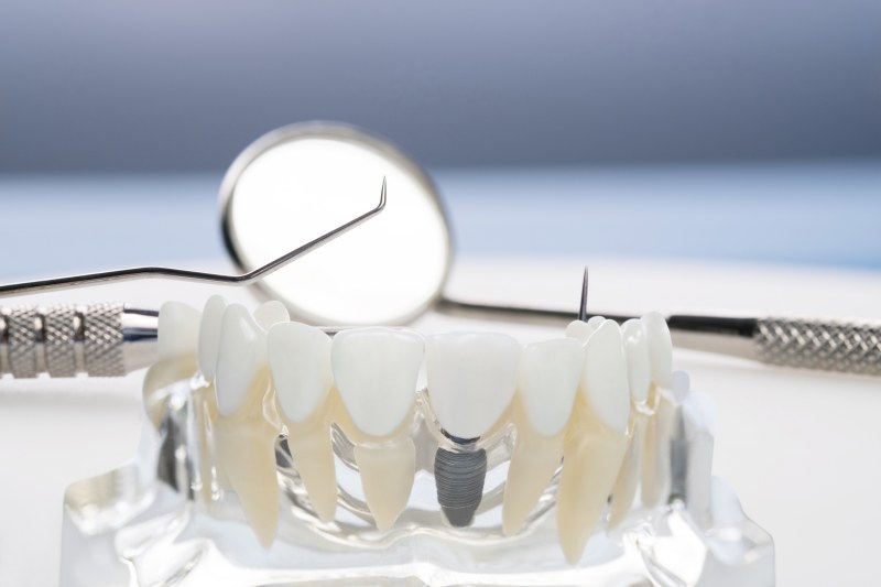  Dental Implants